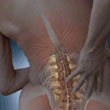 Spinal Stenosis